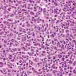 Carcinome sinonasal indifférencié 2